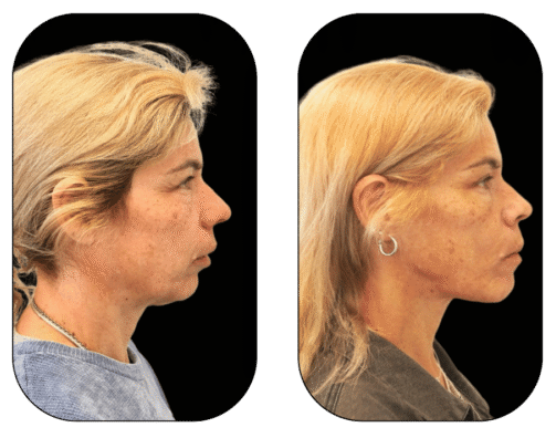 caso 1 harmonização Ortognática bimaxilar + mentoplastia