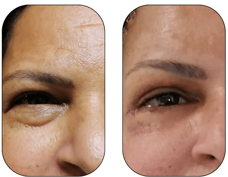 Browlift + blefaroplastia superior e inferior