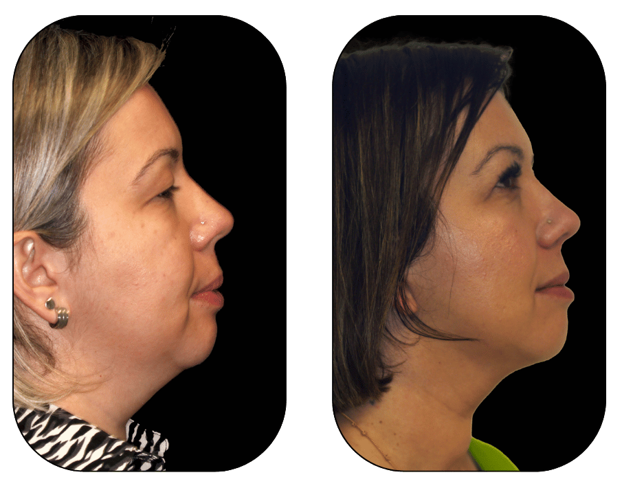 Deep Plane Facelift