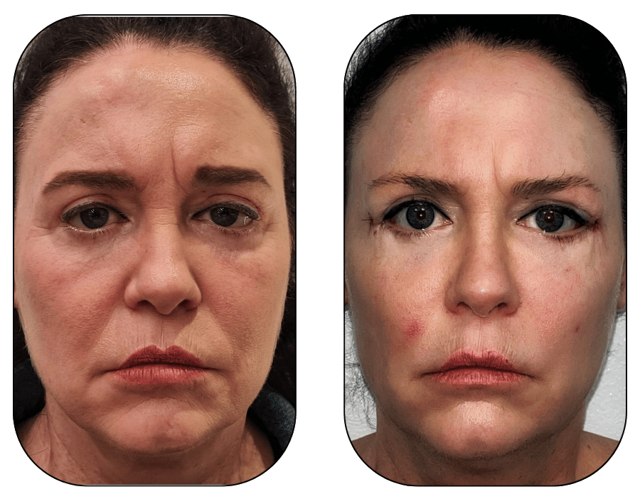 Midface Lift + blefaroplastia inferior