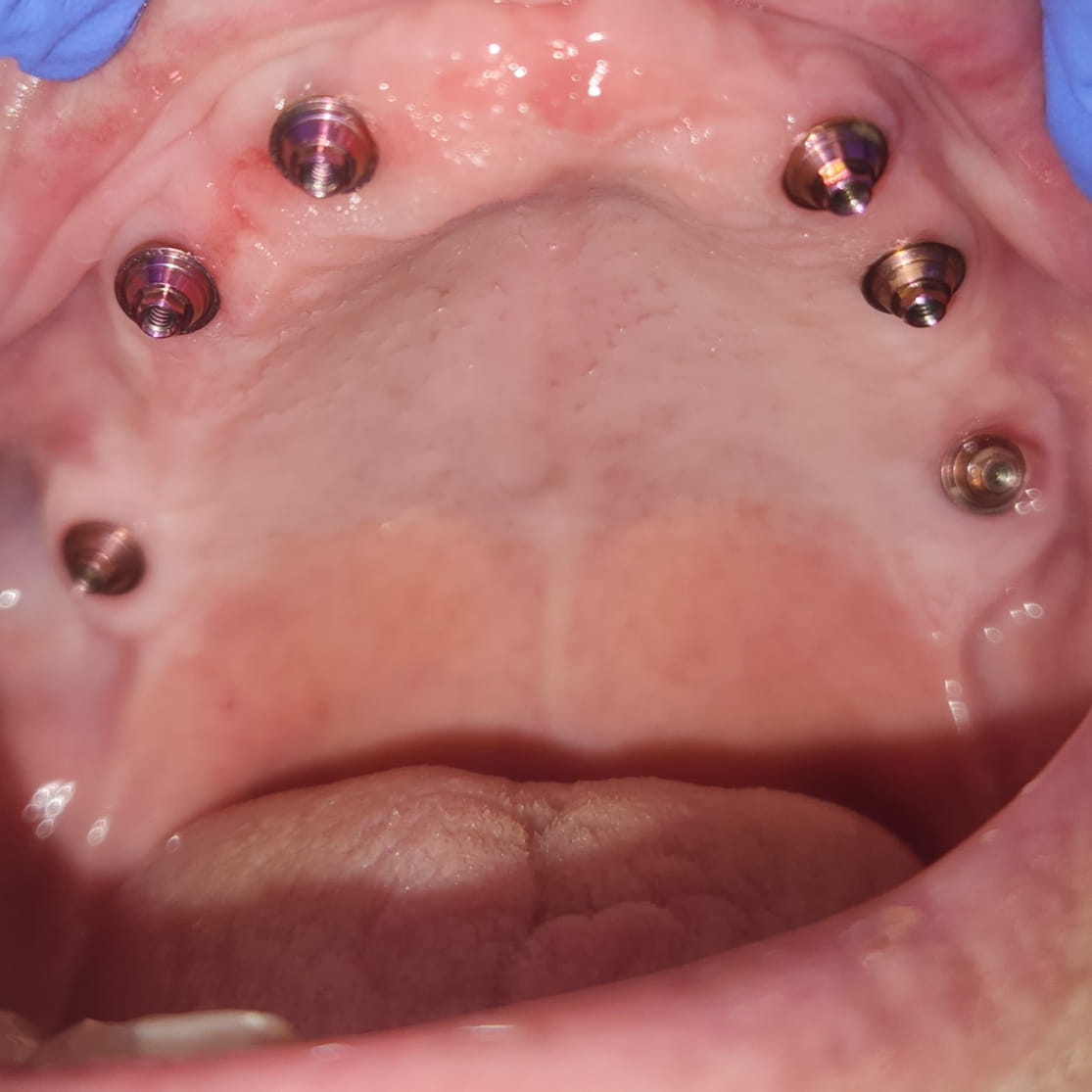 implantes para arco total