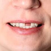 ausência de dente no sorriso