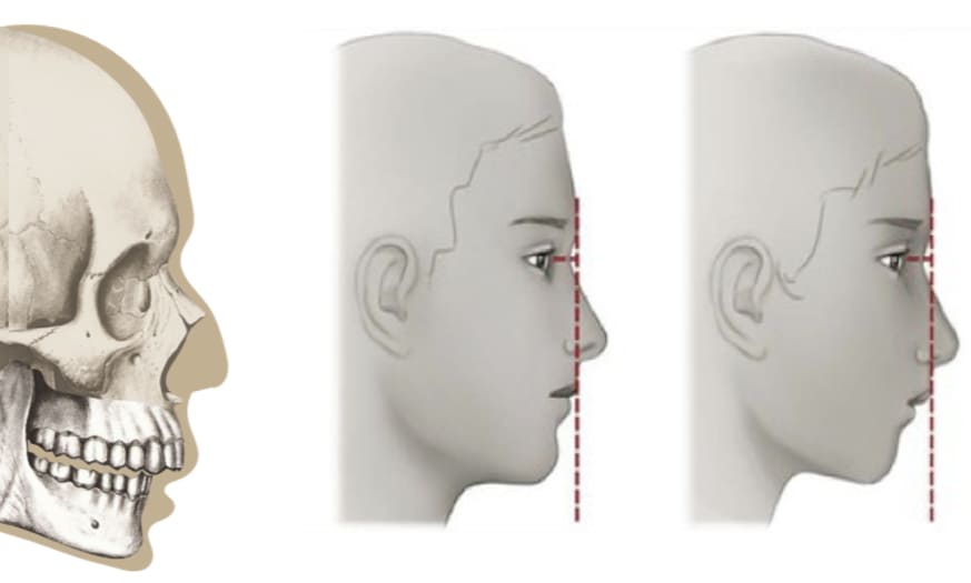 Assimetria Facial e Má Oclusão